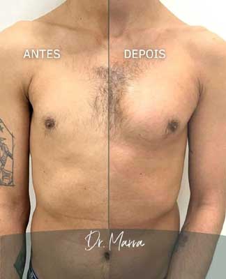 Antes e Depois (Divulgação)